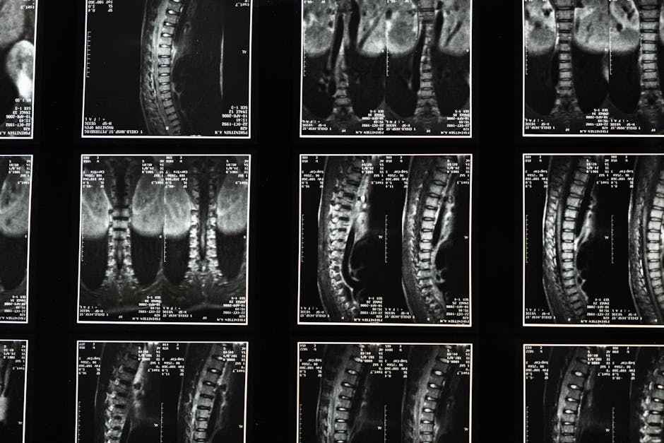 UBE resection completely removed a cervical osteoid osteoma