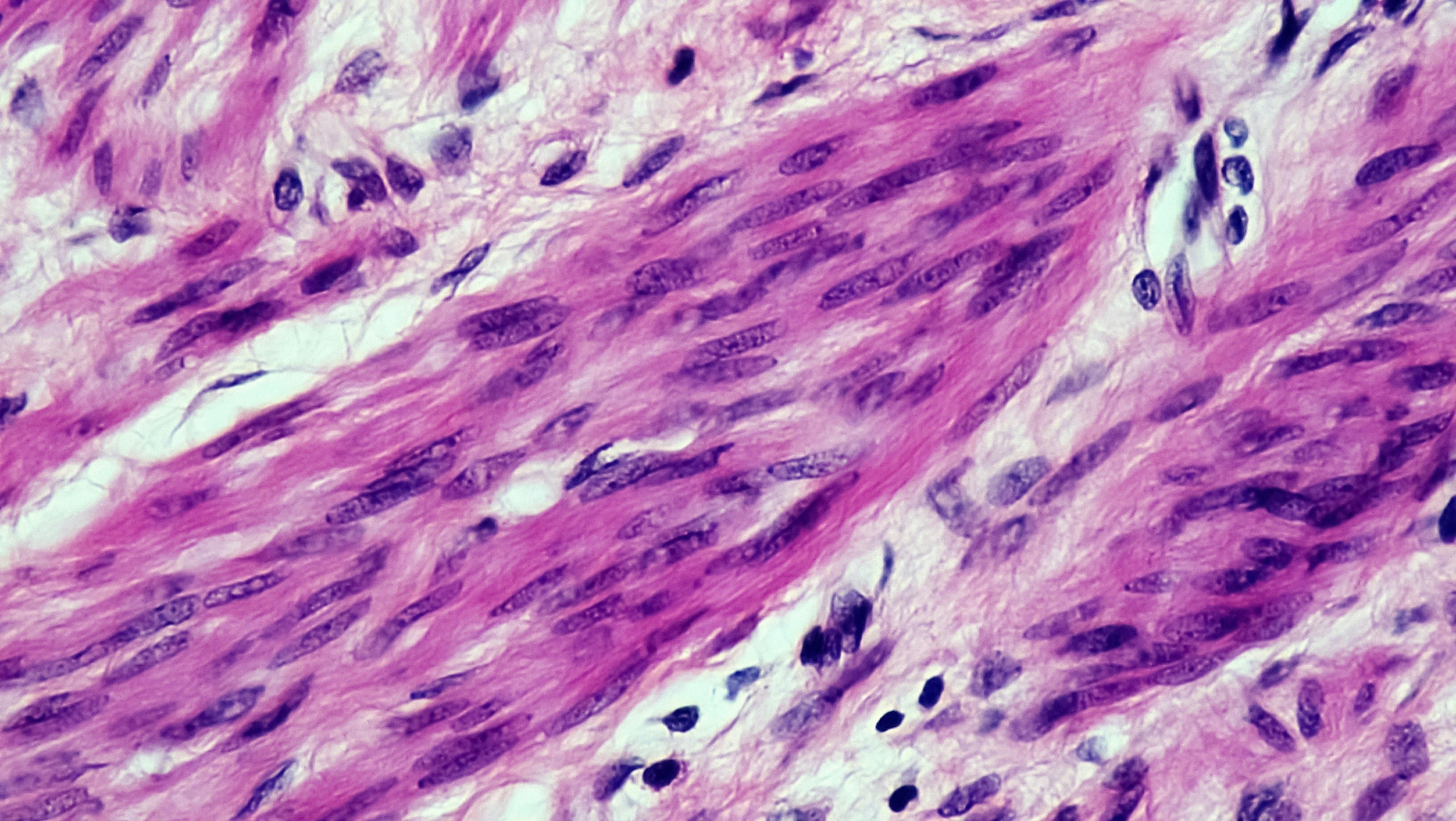 Rare myoepithelial tumor with EWSR1-PBX3 fusion in rib and soft tissue