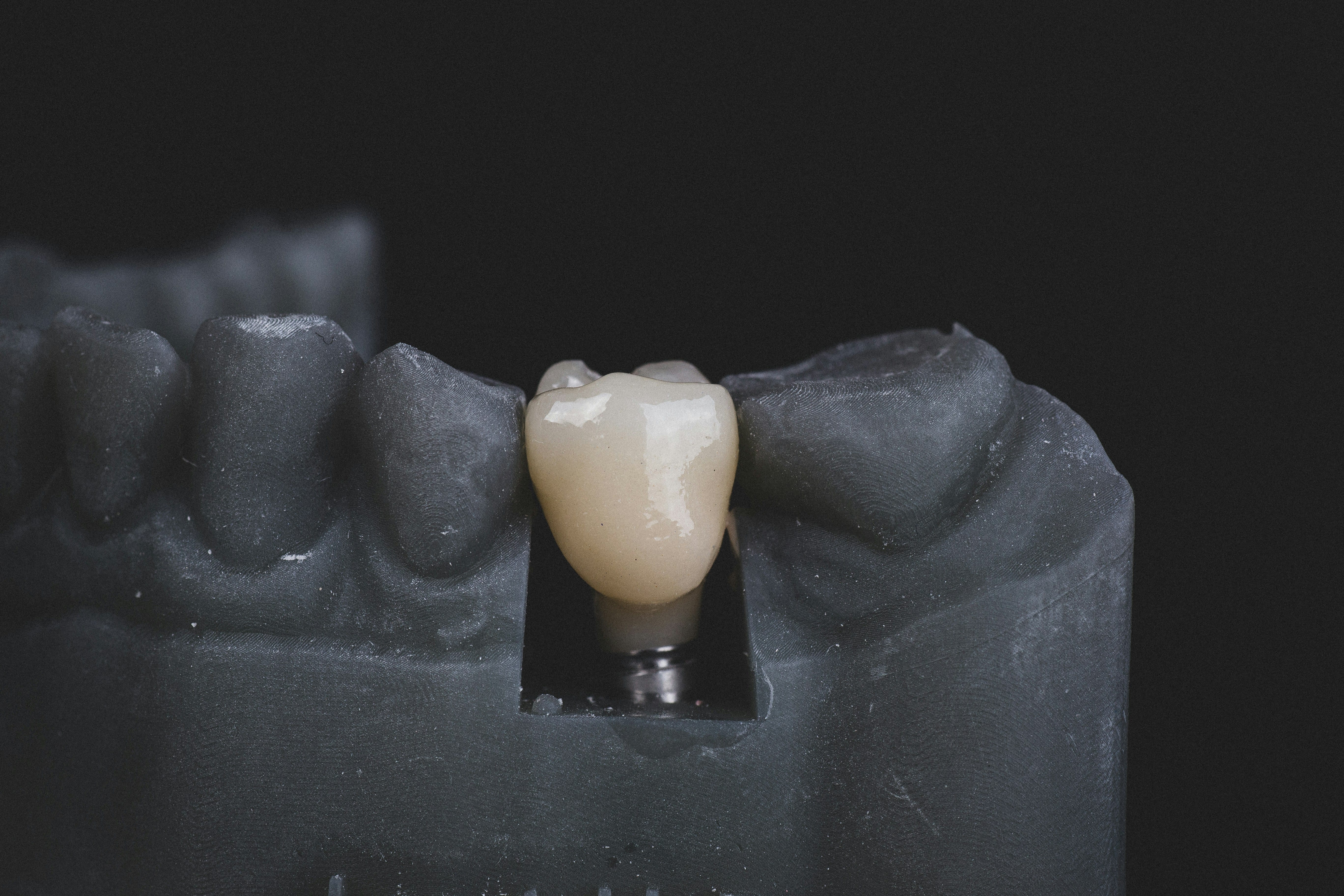Crestal bone loss varied by implant site preparation technique
