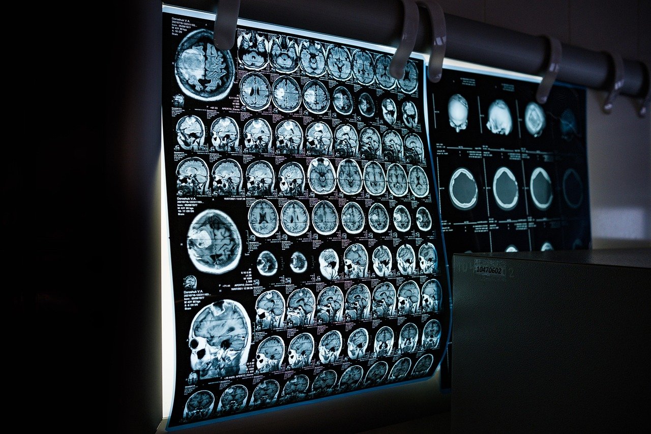 Xenon MRI showed pulmonary gas exchange abnormalities in systemic sclerosis